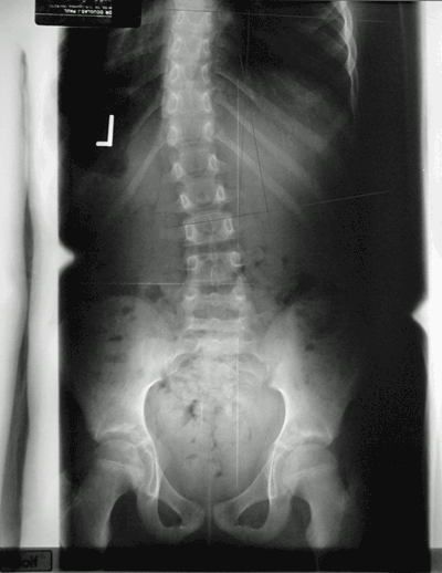 Spine Before Adjustment